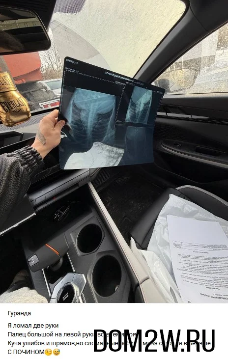 Снимок рёбер Никиты Гуранда