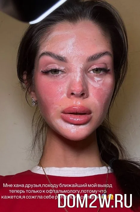 Анна Самонина получила ожог в солярии