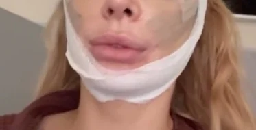 👁️ Кристина Дерябина решилась на модную операцию и удивила подписчиков своим видом